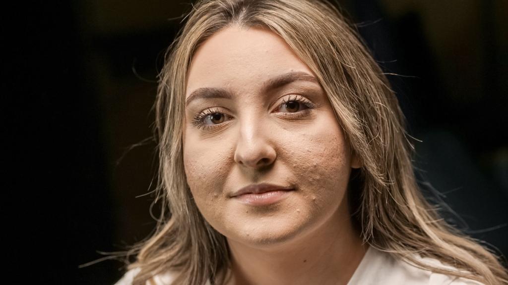 Akne skar arī pieaugušos
